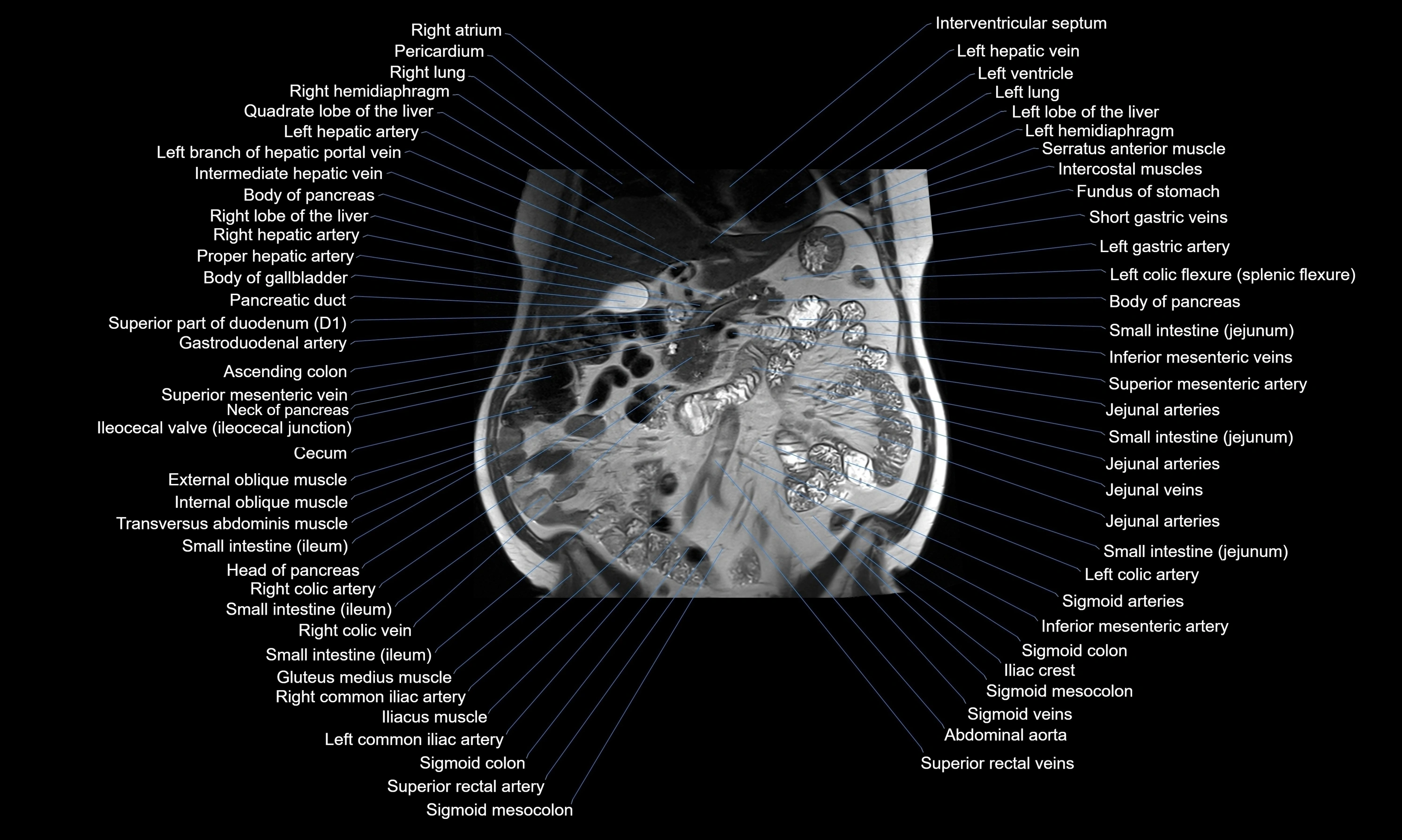 MRI Abdomen axial cross sectional anatomy radiology  image-img-00001-00026.webp
